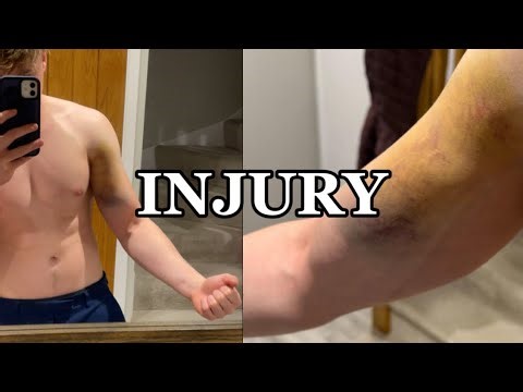 What I learnt after tearing my pec on bench press at 17