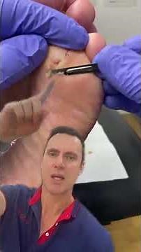 Toe Transformation: Rheumatoid Arthritis Relief Journey #RheumatoidArthritis #ToeHealth