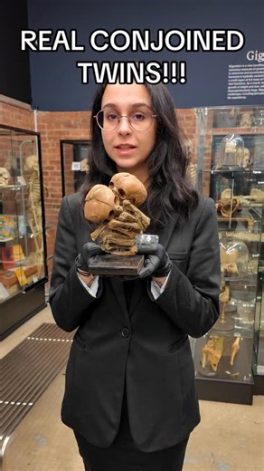 These are thoracopagus conjoined twins on display at the Bone Museum. In a previous video, we explored how conjoined twins form. In this one, we’re focusing on what their anatomy actually looks like. Typically, conjoined twins are artificially straightened to make anatomical structures easier to see. These twins were not. They were preserved in their natural fetal position, a choice that protects their original anatomy, but makes anatomical differentiation far more challenging. To help visualize
