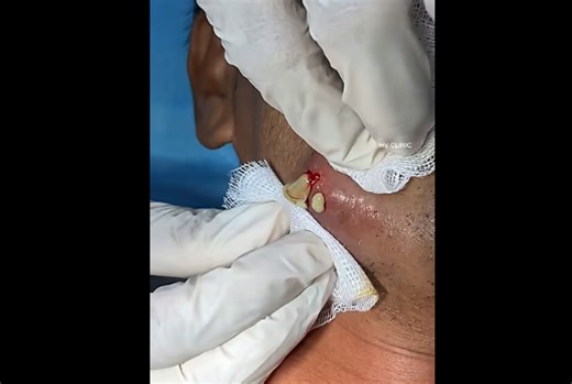 Ingrown Hair Cyst on Jawline Drained