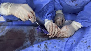 Pro Glide 血管缝合器