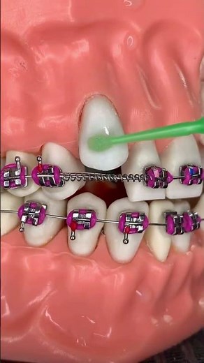 How Teeth Clips (Braces) Work 🦷 Simple Explanation #VelupulaAbhishek #dentalcare #shorts #dentalcare