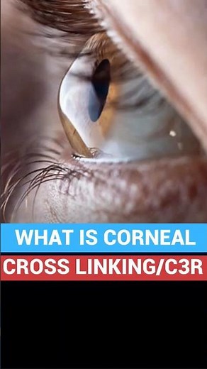 Corneal cross linking (C3R) | Keratoconus Treatment Cost