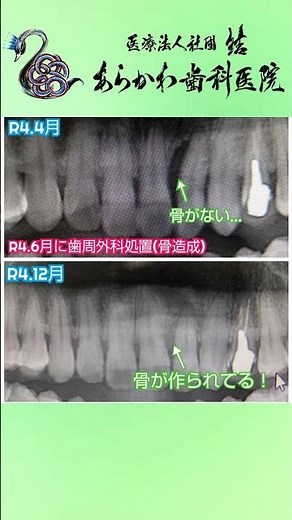 失われた顎の骨が復活！? ～歯周組織再生療法～ #あらかわ歯科医院