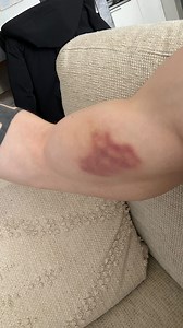 32K views · 137 reactions | The biceps didn’t like that very much若 but all is good • • • #fail #pain #gymnastics #pbars #salto #hurt #biceps #salto | Victor Martinez Marechal | Facebook