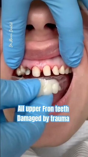 All Front Teeth composite Temporary Crowns ,SMILE DESIGN