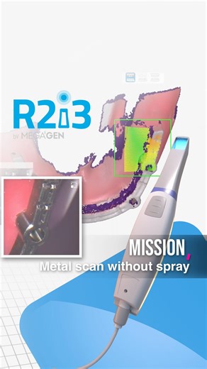 Introducing the groundbreaking metal scan feature of R2i3 ✨ Precise scanning of metal dental prosthetics: 🔹 Overcomes previous challenges faced by ordinary oral scanners 🔹 Provides highly accurate 3D models 🔹 Enables faster and more accurate diagnostics and treatments for patients Experience improved treatment accuracy and efficiency with R2i3’s metal scan technology! Elevate your dental practice to the next level with R2i3 🦷🔍 #digital #digitaldentisty #intraoralscanner #R2i3 #megagen | Meg
