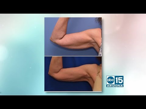 Natural Results Plastic Surgery offers NEW J-Plasma skin tightening treatment