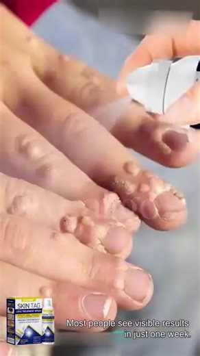 ✨ Get rid of stubborn skin tags in JUST 7 DAYS with Skin Tag Cryo Treatment Spray! ✔️ Uses advanced cryotherapy to freeze and eliminate skin tags from the root. ✔️ No scars, no burning, no harsh chemicals. ✔️ Clinically tested and safe for home use. 👉Get Yours Now https://oujiaknitted.shop/products/skin-cryo-treatment1 | Tanya Garza