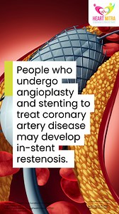 13K views | Following coronary angioplasty, patients face potential complications, including in-stent restenosis. This recurrence of artery narrowing post-stent implantation can lead to serious heart issues. Identifying risk factors and recognizing the symptoms is crucial in preventing complications and safeguarding heart health. #PostStenting #SymptomsOfStenting #HeartHealth #HeartMitra | Heart Mitra | Facebook