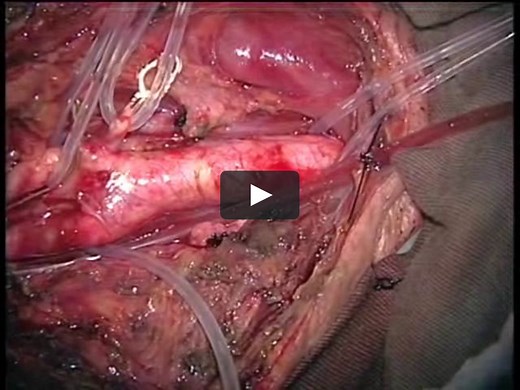 How I Do It: Carotid Endarterectomy