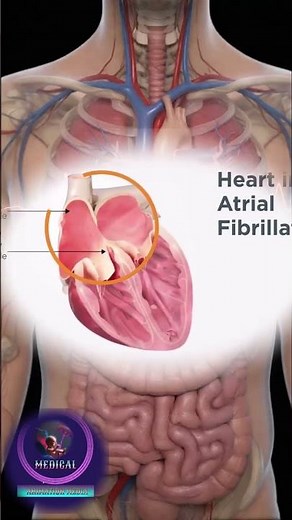 Atrial Fibrillation: Disrupted Electrical Signals and Irregular Heart Rhythm