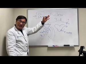 Nuclear CN III palsy