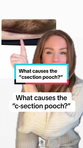 Understanding the C-Section Pooch: Causes and Solutions