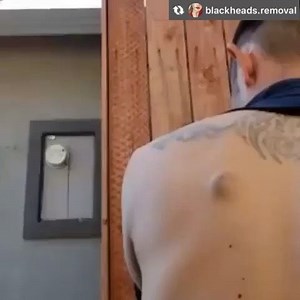 Pimples Extreme | Huge pimple on back!!😱😱😱 Follow @extremepimples for more #Repost from @blackheads.removal OMG!! #blackheadextraction #pimple... | Instagram