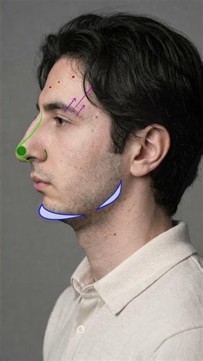 Rhinoplasty & Chin Augmentation in Men | The Art of a Strong Profile