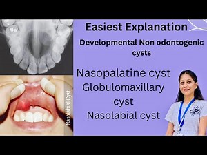 Developmental Non Odontogenic cysts |Oral Pathology BDS |Nasopalatine |Globulomaxillary |Nasolabial