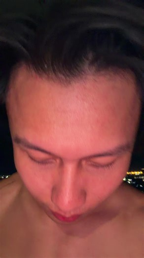 Understanding Stretch Marks: Causes and Solutions