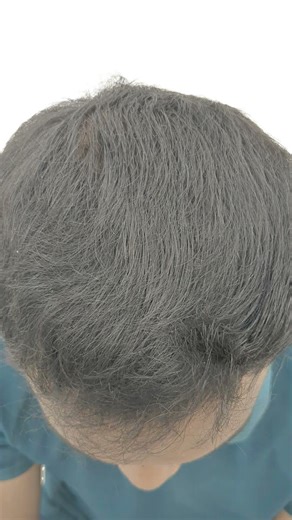 GFC Hair Regrowth Result 😱 Before After