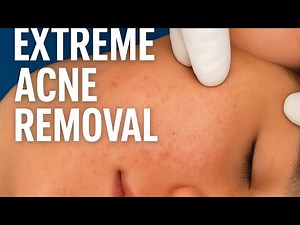 Blackhead Extraction ASMR - The Sounds of Skincare