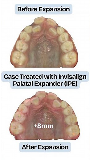 Invisalign Palatal Expander works? | Before After |