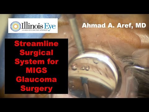 Streamline Surgical System for MIGS Glaucoma Surgery