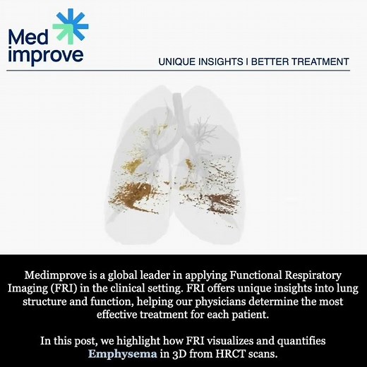 Emphysema as determined by Functional Respiratory Imaging (FRI)