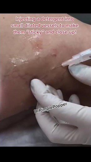 Dr Pimple Popper Performs Sclerotherapy #shorts