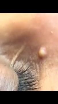Milium (bolinha no rosto)