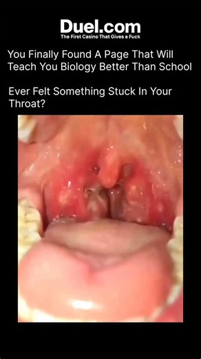 BIOLOGY | MEDICAL | HEALTH on Instagram: "Tonsil stones, or tonsilloliths, are small white or yellow clumps that form deep inside the tiny pockets of your tonsils. They happen when food particles, mucus, and dead cells get trapped and bacteria start breaking them down. Over time, this buildup hardens into a stone-like lump. Even though they’re usually harmless, tonsil stones can cause bad breath, a scratchy throat, ear pain, difficulty swallowing, or a weird taste in your mouth. Many people don’