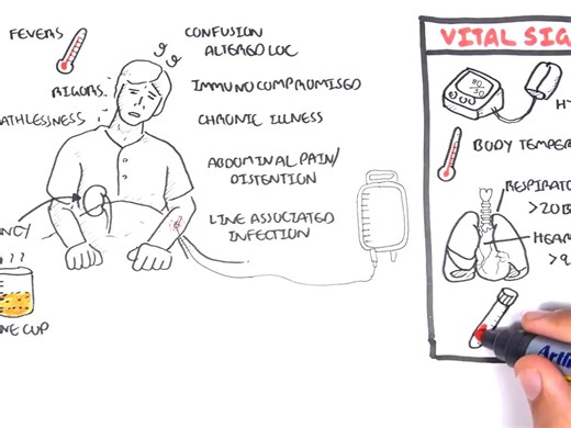 脓毒症治疗简An introduction to the SEPSIS pathway (detect it early and treat it early)