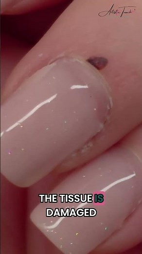 What is a Nail Hematoma? #shorts