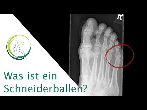 What is a tailor's ball? Podiatrist Andrea explains