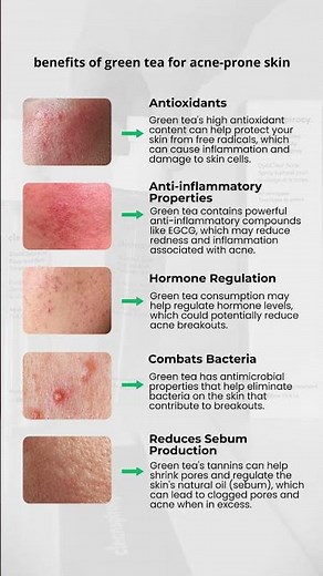 Benefits of Green Tea for Acne-prone Skin