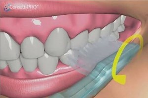 This movie shows the “Fones” technique of tooth brushing. The toothbrush moves in a circular movement over the teeth as it is moved along the arch. Please visit our website: https://implantclinicistanbul.com/ ************************* Bu film, “Fones” diş fırçalama tekniğini göstermektedir. Diş fırçası diş üzerinde ark boyunca dairesel bir hareketle gezdirilir. Detaylı bilgi için: https://erhanaydinlar.com.tr/ #dental #dentist #smile #dentists #dentistry #health #healthcare #healthy #healthylife