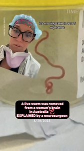 2.3M views · 64K reactions | Throwing back this Wild case of brain worms from last year. In August 2023, doctors removed a 3-inch roundworm from the brain of a 64-year-old Australian woman, marking the first time a worm of this type has been found in a human brain. The worm was identified as an Ophidascaris robertsi, a type of roundworm that's usually found in carpet pythons. #neurosurgery #brainsurgery | Dr. Betsy Grunch - Ladyspinedoc | Facebook