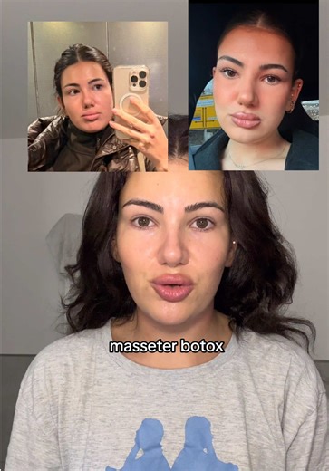 Masseter Botox: Die besten Ergebnisse mit Facelandclinic