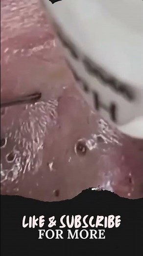 Best ear blackhead removal