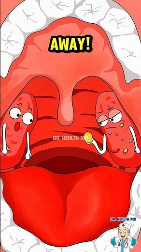 The Hidden Cause of Your Bad Breath Revealed! #tonsilstones #animation