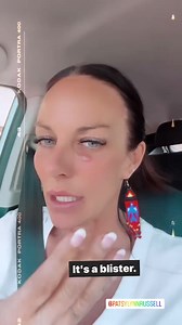 I have always looked up to and adored my Aunt Patsy Lynn Russel! 🌟 With that being said, you may have seen that she had a facial rejuvenation surgery, a.k.a. a facelift! 💁‍♀️ I will share some of her stories in the comments, LOL! 😂 I suppose I decided it was high time for me to take my looks up a notch and decided that I would go get some sunspots frozen off my face! ☀️ Little did I know that when I did this, it would make a blister! 😮 Tomorrow, we have the honor of filming for PBS at the Gr