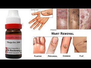 Thuja Occidentalis 200 Benefits, Uses, Dosage, Review, Price, Side effects in Hindi | Review Remedy