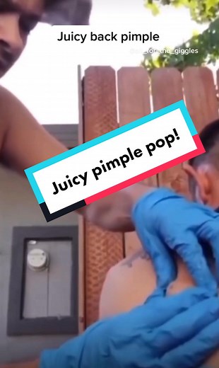 Huge back pimple pop. #cystpopping #pimplepoppingprofessional #dilatedpore #whiteheadsremoval #blackheadremovals #dilatedporeofwiner
