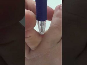 Scratching between itchy toe with pen