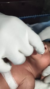 So cute baby putting OG tube #workout #trendingreelsl #viralreelsシ #newsupdate2025 #fbreelsfypシ゚viralfbreelsfypシ゚viral #mentalhealth | chintu nicu nursing stm