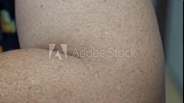 Arm muscle twitching. Muscle spasms.