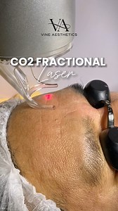 How does CO2 Fractional Laser transform your skin? ✨ Watch this video as CO2 Fractional Laser removes layers of skin tissue in a fractionated method. Columns of skin are removed, leaving the skin surrounding each column intact to aid healing—improving skin’s laxity, reducing age-related pigmentation, and smoothing skin. The fractional technology of the carbon dioxide laser allows for better resurfacing and correction of skin imperfections, with noted results after the first treatment. ✔️ Stretch