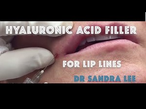 Treating lip lines, and downturned lips with a hyaluronic acid filler