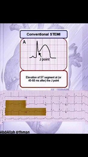 ✨🫀STEMI equivalents. Mrcp Mini #ecg #ekg #ecginterpretation 🔇 #cardiology #MedicalEducation #hearthealth ✨ @topfans | Abdallah Othman