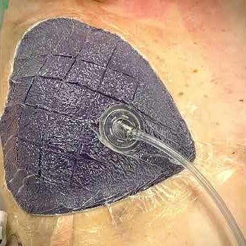 Vacuum dressings for breast surgery reduces complications (BellaForm)