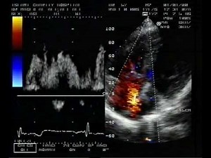 Ostium Secundum Atrial Septal Defect And Perimembranous Ventricular Septal Defect • Video • MEDtube.net